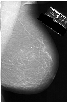Digital Database for Screening Mammography