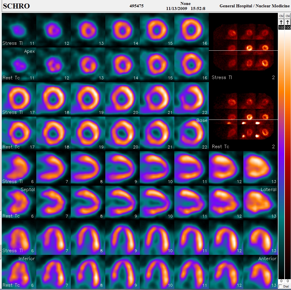 Image slices in a nuclear medicine study