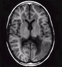 MRI Brain