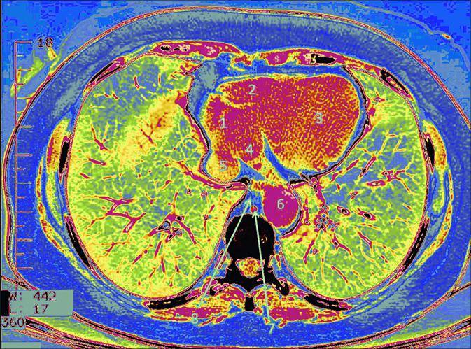 LUNGS AND HEART TOMOGRAPHY