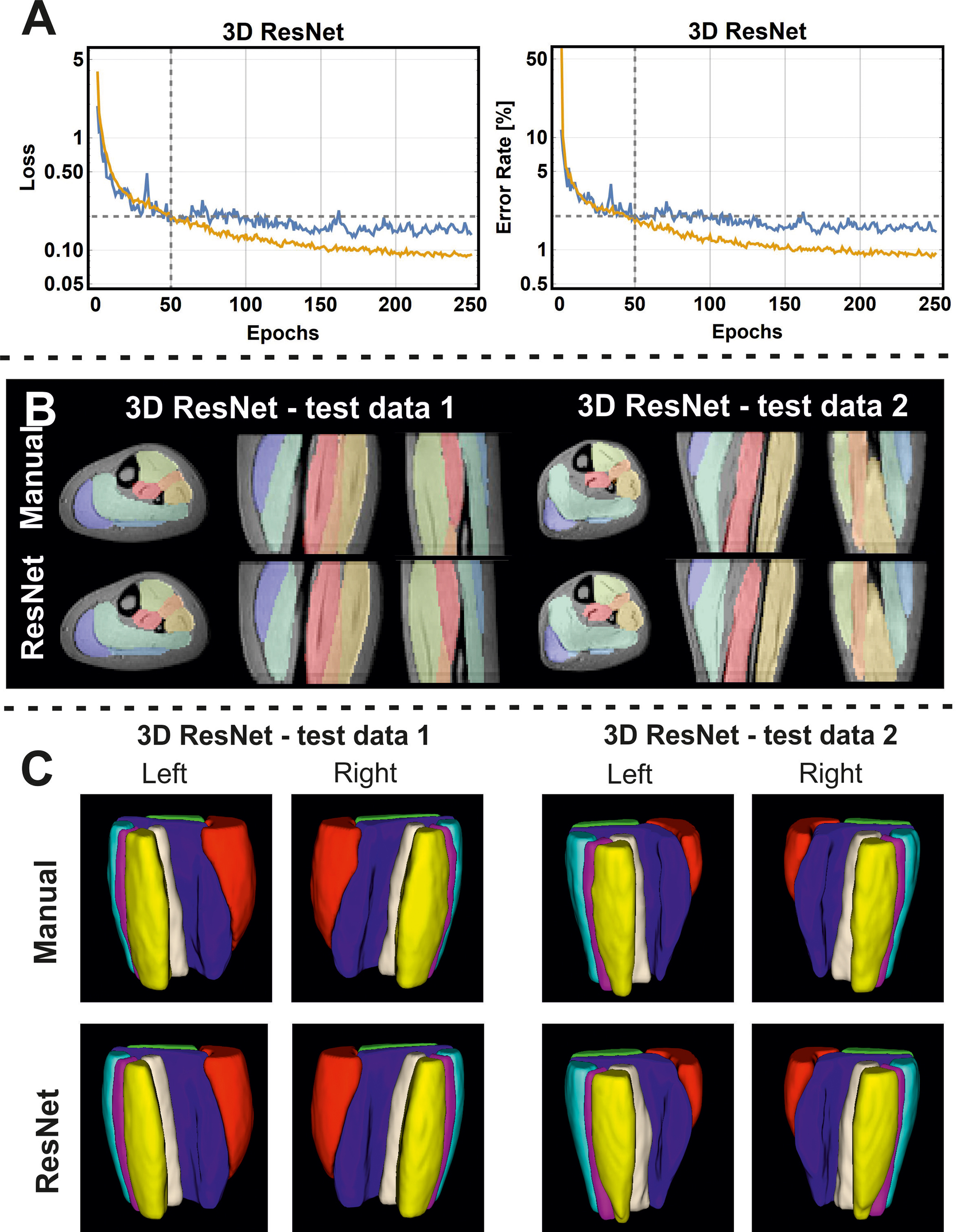Automated 3D muscle segmentation using UNET / RESNET using DIXON MRI data